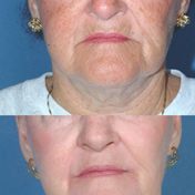 pics patient before and after Full Face Rejuvenation