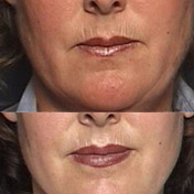 images patient before and after Full Face Rejuvenation