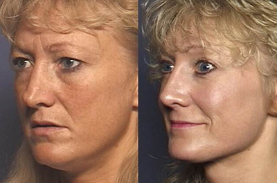 photos before and after Full Face Rejuvenation