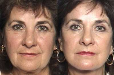 front view before and after Full Face Rejuvenation