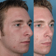 Full Face Rejuvenation - photos patient before and after