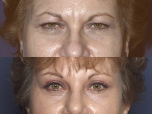 PROCEDURES: Forehead and Eyebrow - Before and After Photos: Female Patient (frontal view)