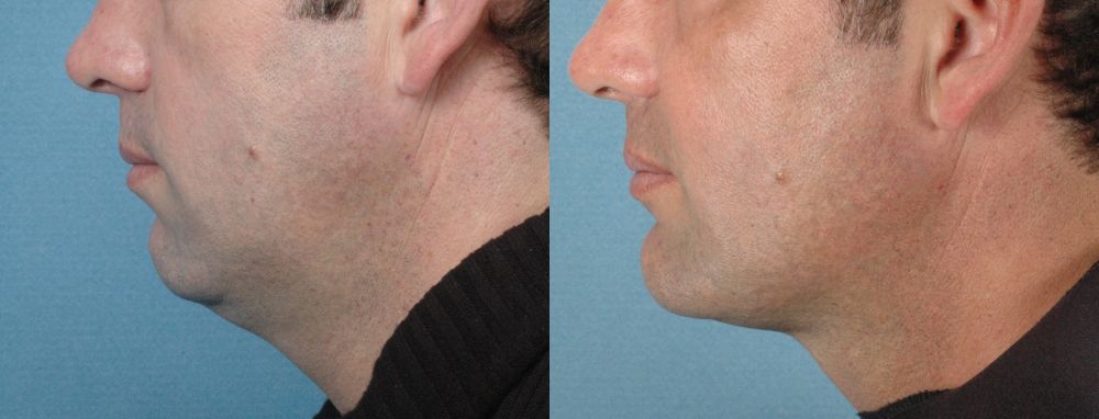 LOWER FACE - Chin Implant - Before and After Photos: Male (left side view)