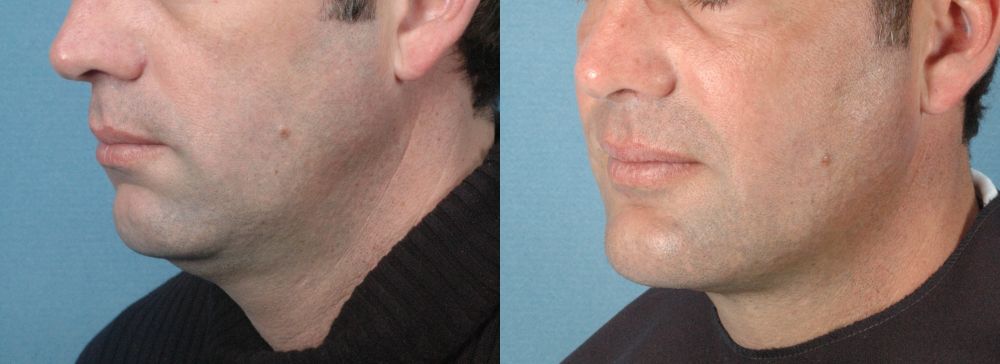 LOWER FACE - Chin Implant - Before and After Photos: Male (left side, oblique view)
