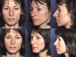 LOWER FACE: Chin implant with rhinoplasty - Before and After Photos: Female
