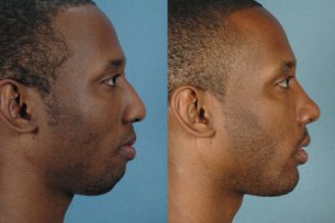 LOWER FACE - Chin implant with septorhinoplasty - Male before and after photos (right side view)