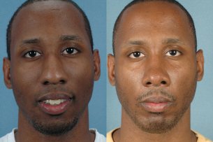 LOWER FACE - Chin implant with septorhinoplasty - Male before and after photos (frontal view)