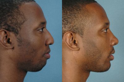 Chin Implant - pics patient before and after