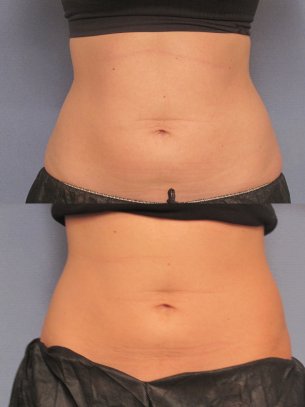 pics patient before and after CoolSculpting