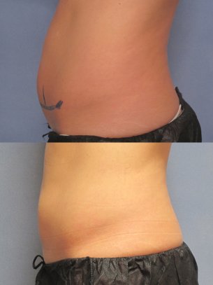 CoolSculpting images patient before and after 