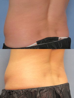 CoolSculpting photos patient before and after 