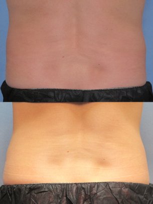 CoolSculpting images before and after 