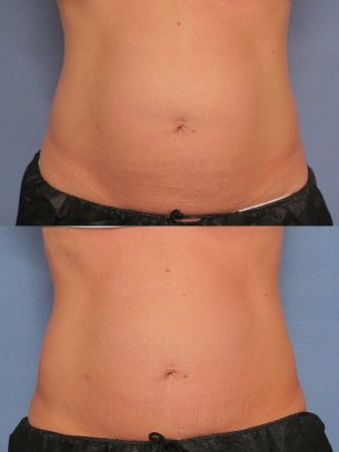 before and after CoolSculpting procedures - pics