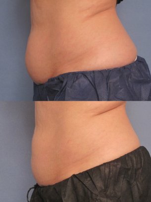 before and after CoolSculpting procedures - photos abdominal area