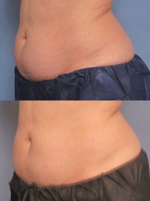 before and after CoolSculpting procedures - pics of patient