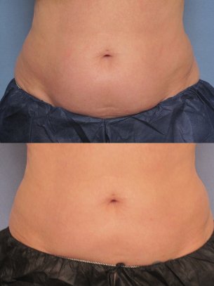 before and after CoolSculpting procedures - images of patient