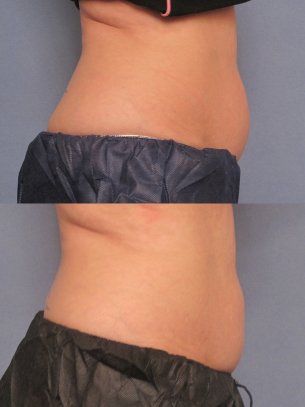 before and after CoolSculpting procedures - photos of patient
