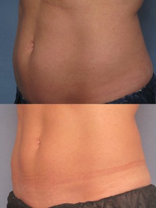 images abdominal area before and after CoolSculpting