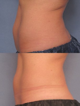 before and after CoolSculpting procedures - images abdominal area
