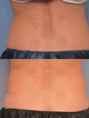 before and after CoolSculpting procedures - pics abdominal area