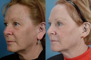 Chin Implant - photos before and after