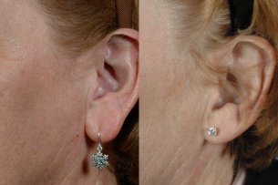 Ear Lobe Reduction - Before And After Treatment - Female (left side, oblique view)