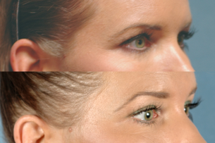 EYES - Ultherapy. Before and After Photos - Female patient (right side, oblique view)