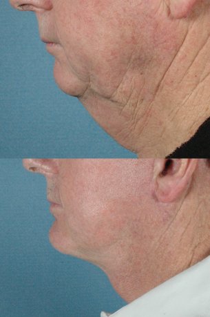 LOWER FACE - Jaw and necklift (facelift) with chin implant|Before and After Photos - Male (left side view)