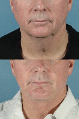 LOWER FACE - Jaw and necklift (facelift) with chin implant|Before and After Photos - Male (frontal view)