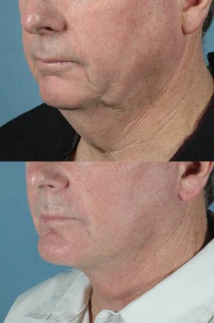 LOWER FACE - Jaw and necklift (facelift) with chin implant|Before and After Photos - Male (left side, oblique view)