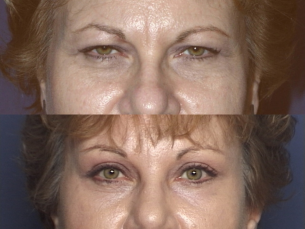 FOREHEAD AND BROWS: Before and After Treatment Photos: Female (frontal view)