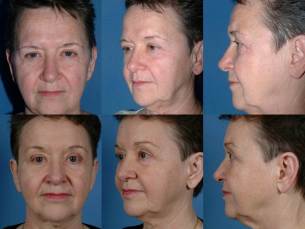 FOREHEAD AND BROWS: Before and After Treatment Photos: Female patient (frontal, oblique and side - views)