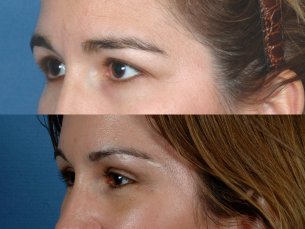FOREHEAD AND BROWS: Before and After Treatment Photos: Woman patient (left side, oblique view)