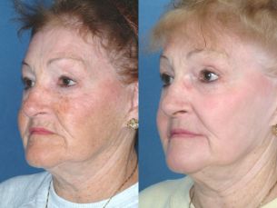 Full Face Rejuvenation - Before And After Photos: Female (left side, oblique view)