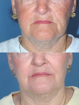 Full Face Rejuvenation - Before And After Photos: Female (frontal view)