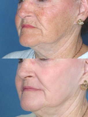 Full Face Rejuvenation - Before And After Photos: Female patient (left side, oblique view)
