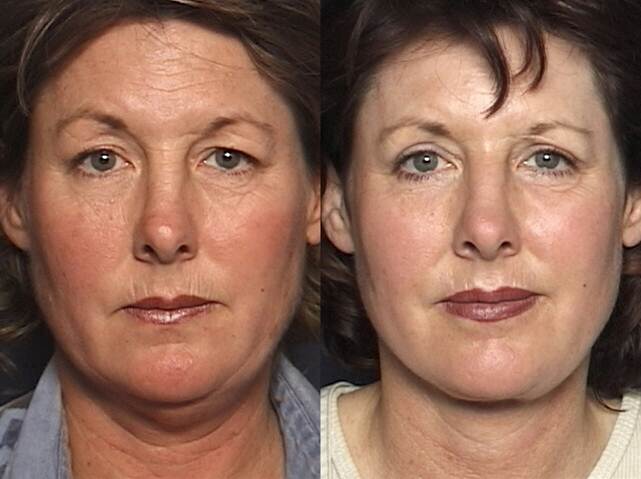 Before And After Photos: Full Face Rejuvenation - Female patient (frontal view)