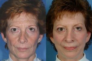 Before And After Photos: Full Face Rejuvenation - Woman (frontal view)