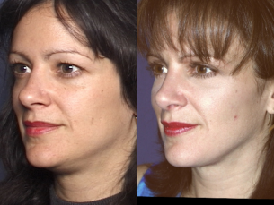 LOWER FACE | Liposculpture | Before and After Treatment Photos: Female (left side, oblique view)