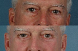 EYES - Lower Blepharoplasty - Before and After Treatment Photos: Male (frontal view)