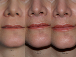 MOUTH AND LIPS | Photos: Before and After Treatment - Woman