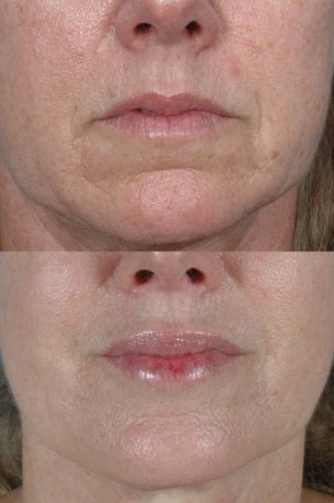 MOUTH AND LIPS | Before and After Treatment - Female patient (frontal view)