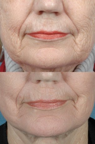 Perioral Laser Resurfacing - Before and After Photos: Female (frontal view)