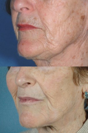 pics before and after Perioral Laser Resurfacing