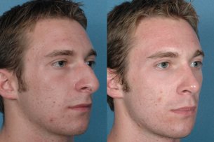 Before and After Photos: Nose - Male (right side view)