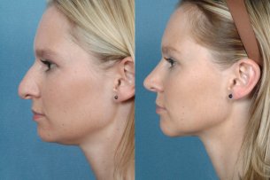 Before and After Treatment Photo - Nose (female, left side view)