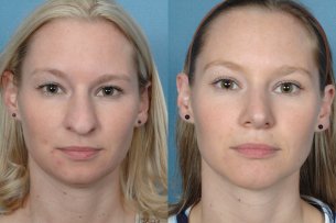 Before and After Treatment Photo - Nose (female, frontal view)