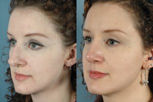 NOSE |Septorhinoplasty| Before and After treatment - Photo: Female (oblique view)