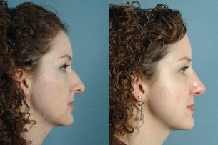 NOSE |Septorhinoplasty| Before and After treatment - Photo: Female (right side view)