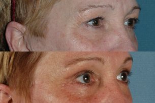 Upper Blepharoplasty | Eyes | Photos: Before and After Treatments - Female (oblique view)